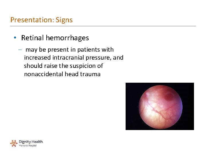 Presentation: Signs • Retinal hemorrhages – may be present in patients with increased intracranial