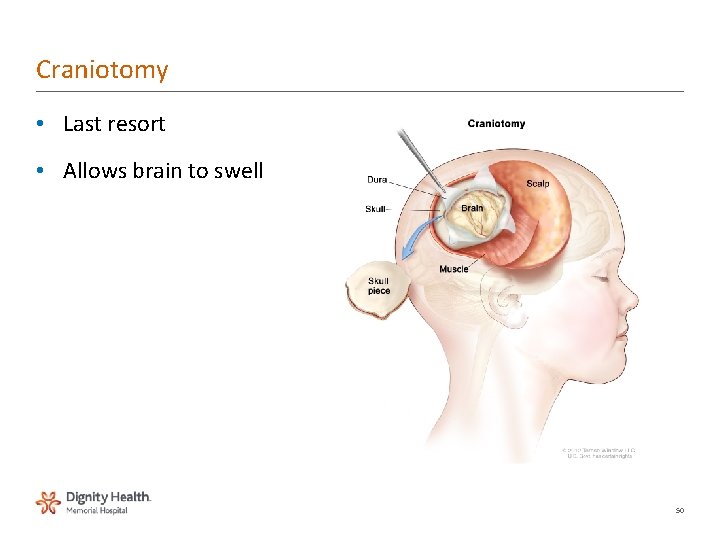 Craniotomy • Last resort • Allows brain to swell 50 