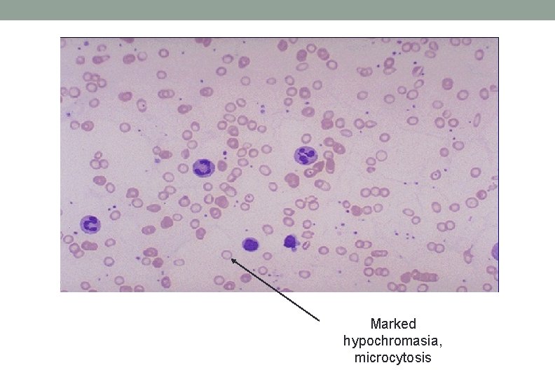 Marked hypochromasia, microcytosis Marked hypochromasia, microcytosis