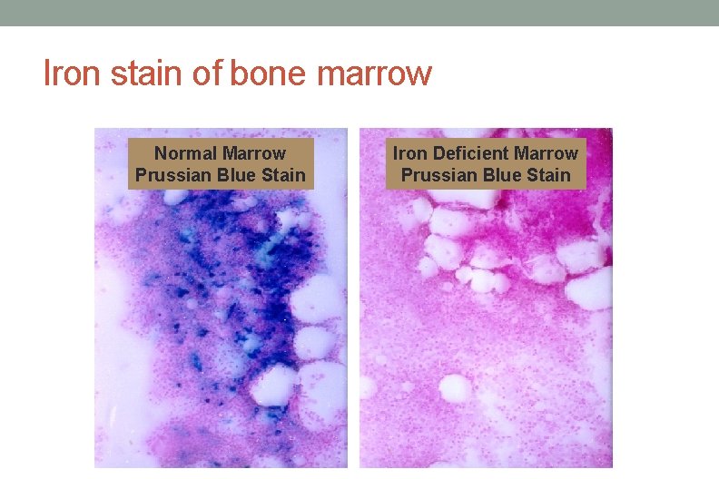 Iron stain of bone marrow Normal Marrow Prussian Blue Stain Iron Deficient Marrow Prussian