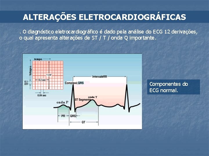 ALTERAÇÕES ELETROCARDIOGRÁFICAS. O diagnóstico eletrocardiográfico é dado pela análise do ECG 12 derivações, o