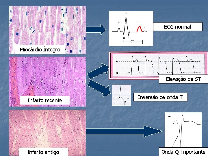 ECG normal Miocárdio Íntegro Elevação de ST Infarto recente Infarto antigo Inversão de onda