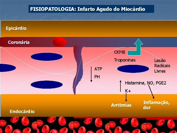 FISIOPATOLOGIA: Infarto Agudo do Miocárdio Epicárdio Coronária CKMB Troponinas ATP Lesão Radicais Livres PH