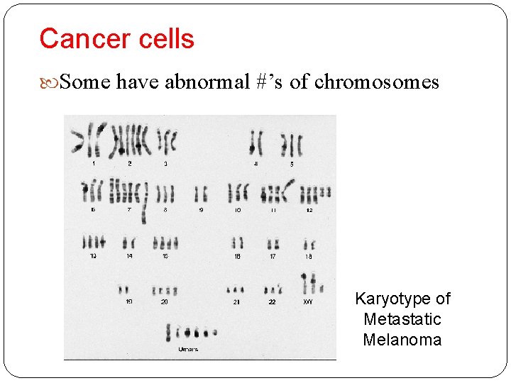 Cancer cells Some have abnormal #’s of chromosomes Karyotype of Metastatic Melanoma 