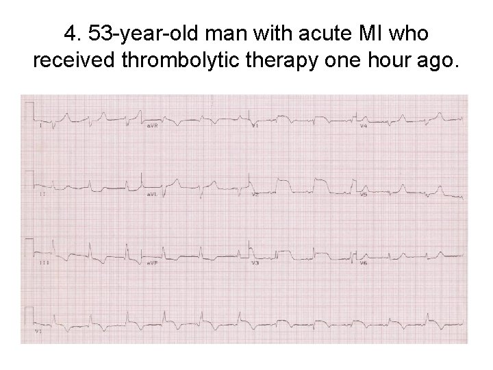 4. 53 -year-old man with acute MI who received thrombolytic therapy one hour ago.