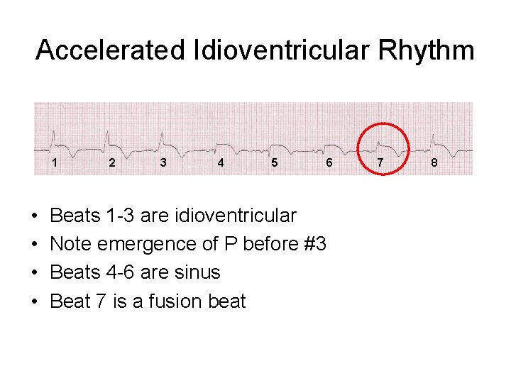 Accelerated Idioventricular Rhythm 1 • • 2 3 4 5 6 Beats 1 -3