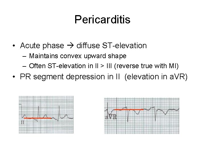 Pericarditis • Acute phase diffuse ST-elevation – Maintains convex upward shape – Often ST-elevation