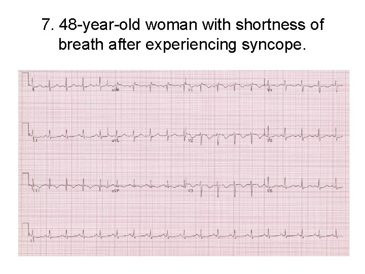 7. 48 -year-old woman with shortness of breath after experiencing syncope. 