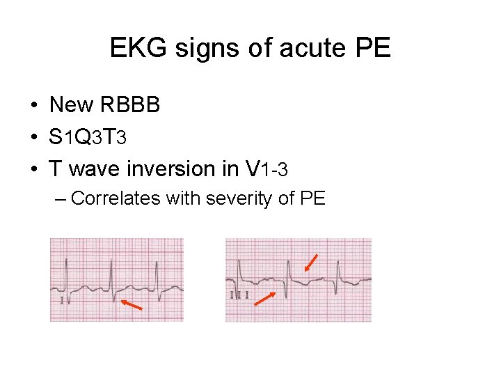 EKG signs of acute PE • New RBBB • S 1 Q 3 T