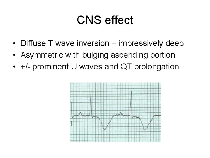 CNS effect • Diffuse T wave inversion – impressively deep • Asymmetric with bulging