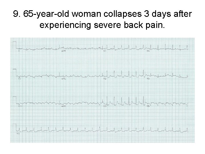 9. 65 -year-old woman collapses 3 days after experiencing severe back pain. 