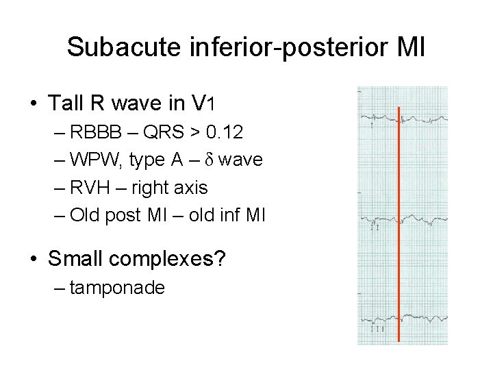 Subacute inferior-posterior MI • Tall R wave in V 1 – RBBB – QRS