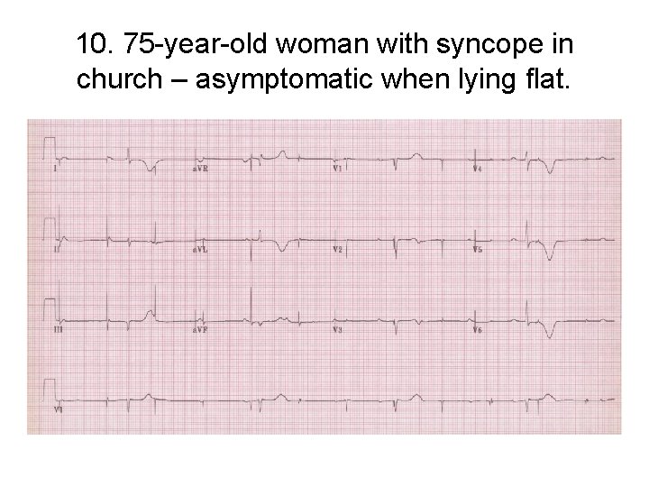 10. 75 -year-old woman with syncope in church – asymptomatic when lying flat. 