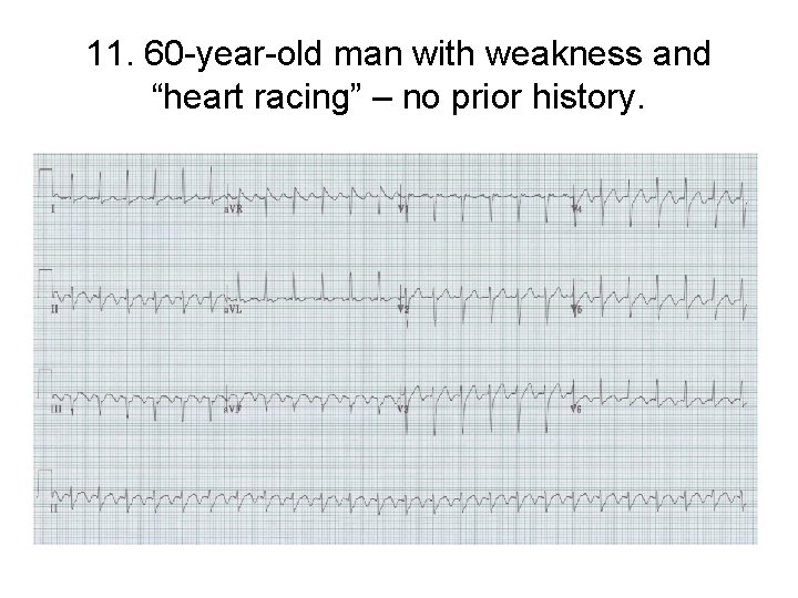 11. 60 -year-old man with weakness and “heart racing” – no prior history. 