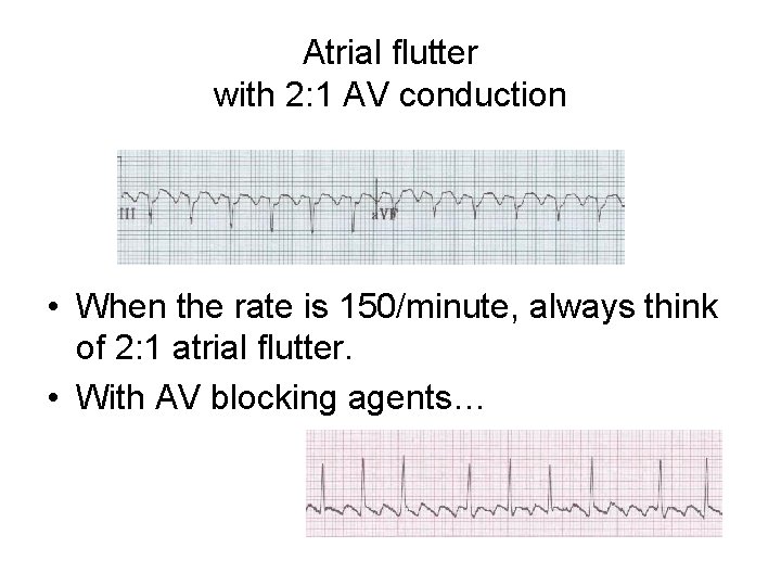 Atrial flutter with 2: 1 AV conduction • When the rate is 150/minute, always