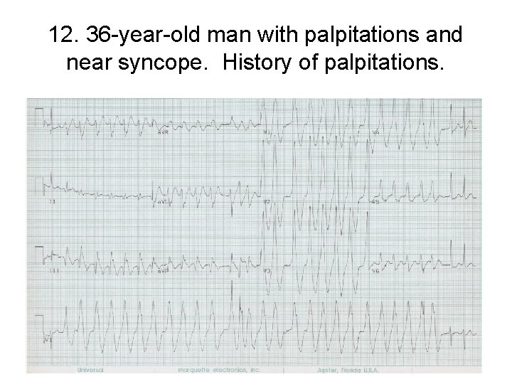 12. 36 -year-old man with palpitations and near syncope. History of palpitations. 