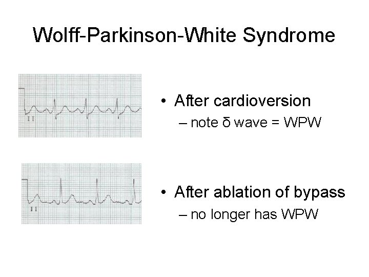 Wolff-Parkinson-White Syndrome • After cardioversion – note δ wave = WPW • After ablation