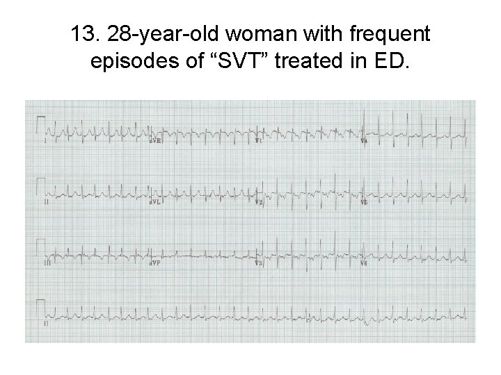 13. 28 -year-old woman with frequent episodes of “SVT” treated in ED. 