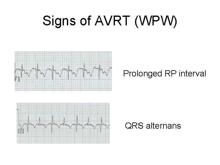 Signs of AVRT (WPW) Prolonged RP interval QRS alternans 