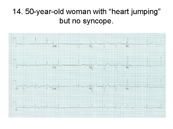 14. 50 -year-old woman with “heart jumping” but no syncope. 