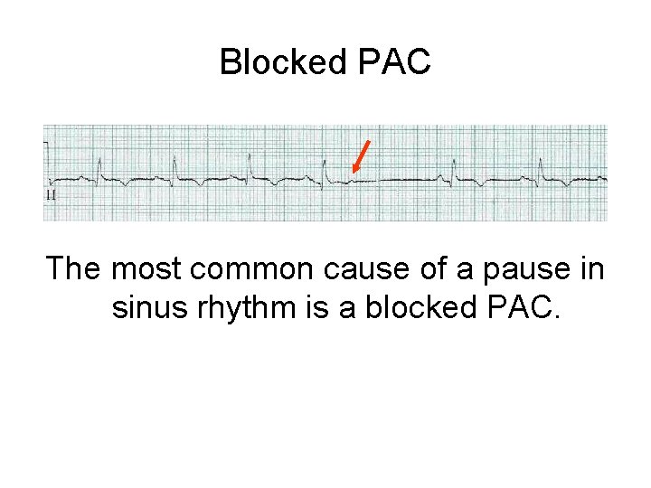 Blocked PAC The most common cause of a pause in sinus rhythm is a