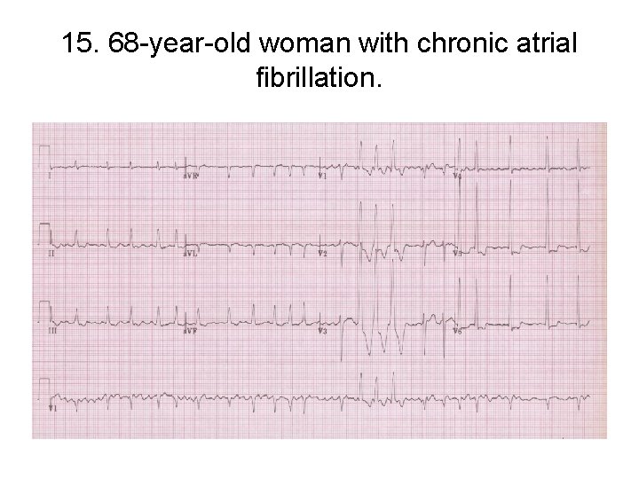 15. 68 -year-old woman with chronic atrial fibrillation. 