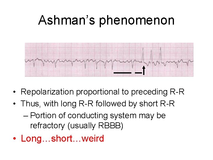 Ashman’s phenomenon V 1 • Repolarization proportional to preceding R-R • Thus, with long