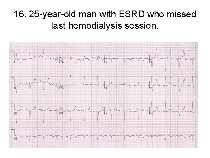 16. 25 -year-old man with ESRD who missed last hemodialysis session. 