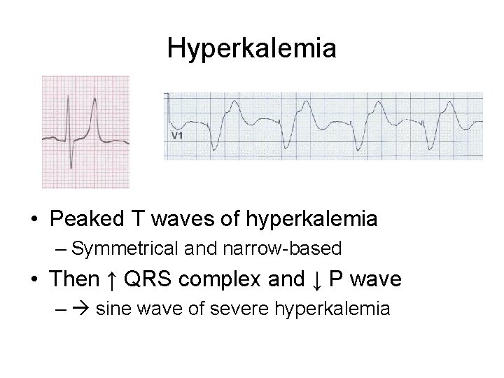 Hyperkalemia • Peaked T waves of hyperkalemia – Symmetrical and narrow-based • Then ↑