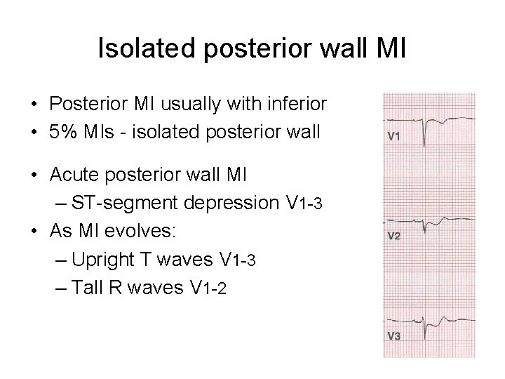 Isolated posterior wall MI • Posterior MI usually with inferior • 5% MIs -