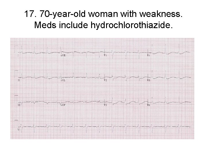 17. 70 -year-old woman with weakness. Meds include hydrochlorothiazide. 