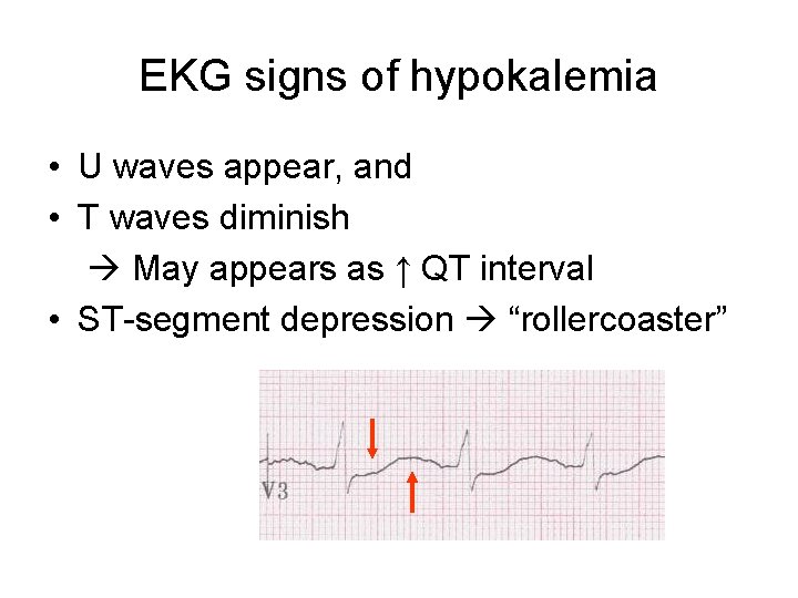 EKG signs of hypokalemia • U waves appear, and • T waves diminish May