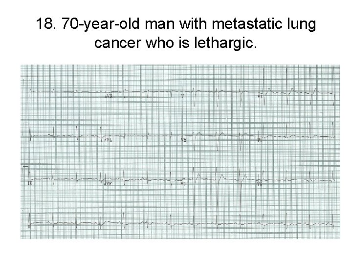 18. 70 -year-old man with metastatic lung cancer who is lethargic. 