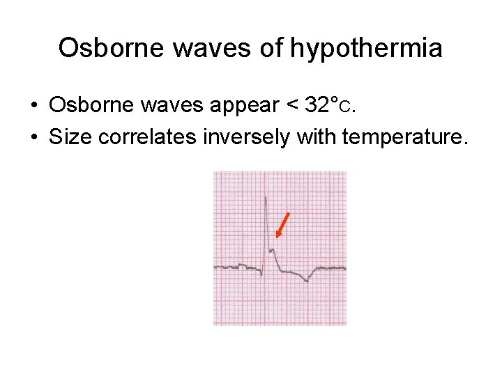 Osborne waves of hypothermia • Osborne waves appear < 32°C. • Size correlates inversely