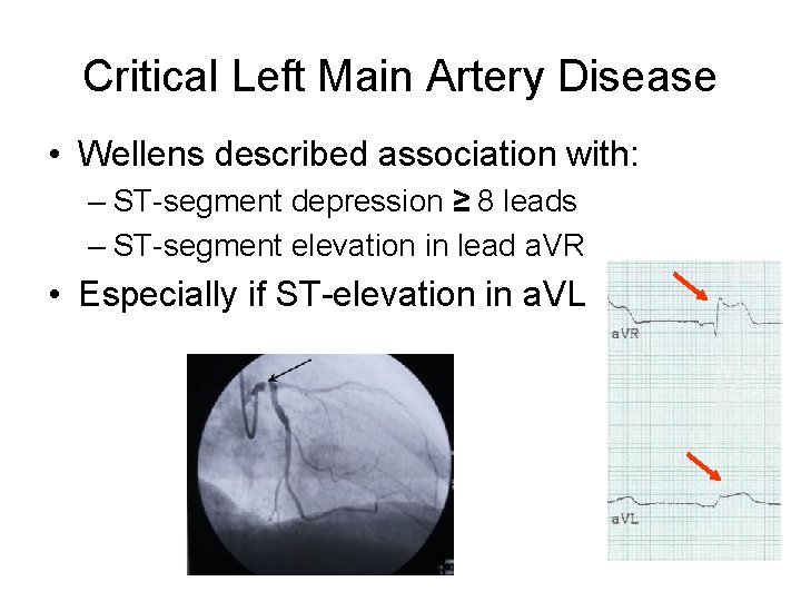 Critical Left Main Artery Disease • Wellens described association with: – ST-segment depression ≥