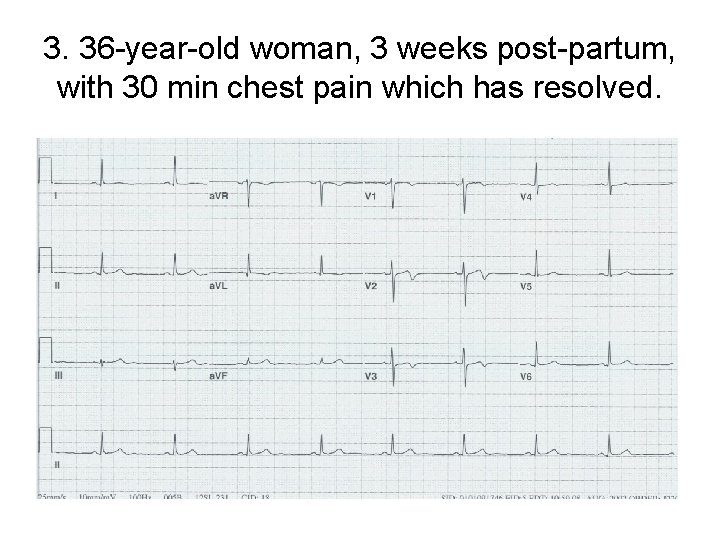 3. 36 -year-old woman, 3 weeks post-partum, with 30 min chest pain which has