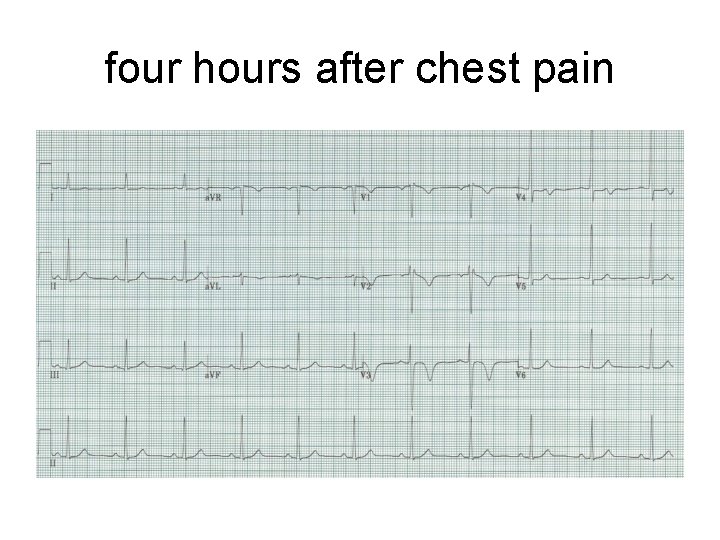 four hours after chest pain 