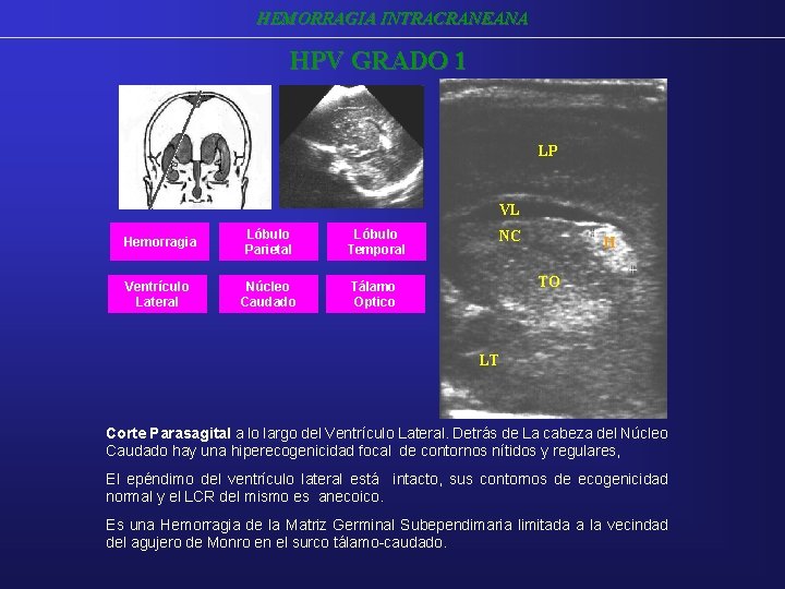 HEMORRAGIA INTRACRANEANA HPV GRADO 1 LP VL Hemorragia Lóbulo Parietal Lóbulo Temporal Ventrículo Lateral HEMORRAGIA INTRACRANEANA HPV GRADO 1 LP VL Hemorragia Lóbulo Parietal Lóbulo Temporal Ventrículo Lateral