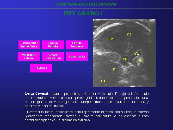 HEMORRAGIA INTRACRANEANA HPV GRADO 1 CI LP Cisura Inter hemisférica Lóbulo Parietal Lóbulo Temporal HEMORRAGIA INTRACRANEANA HPV GRADO 1 CI LP Cisura Inter hemisférica Lóbulo Parietal Lóbulo Temporal