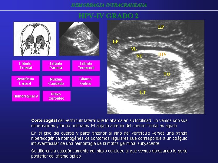 HEMORRAGIA INTRACRANEANA HPV-IV GRADO 2 LP LF VL NC Lóbulo Frontal Lóbulo Parietal HIV HEMORRAGIA INTRACRANEANA HPV-IV GRADO 2 LP LF VL NC Lóbulo Frontal Lóbulo Parietal HIV