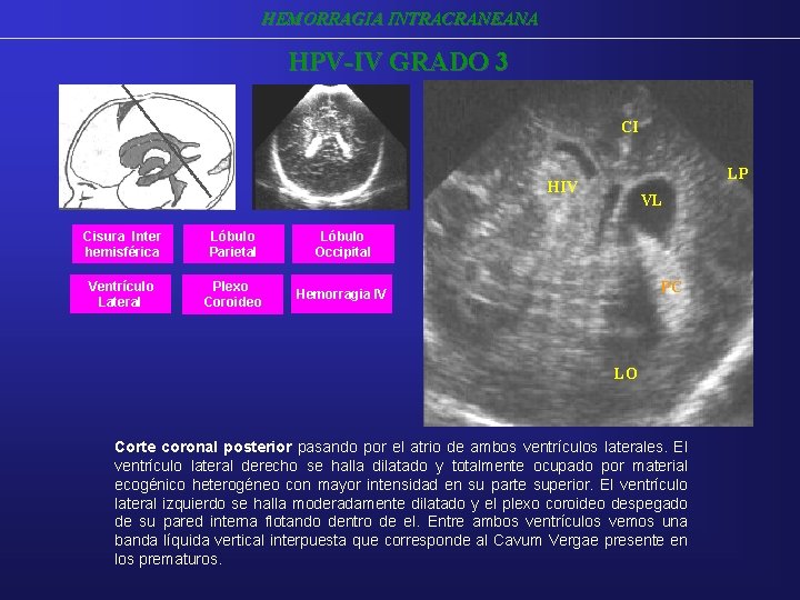 HEMORRAGIA INTRACRANEANA HPV-IV GRADO 3 CI LP HIV Cisura Inter hemisférica Lóbulo Parietal Lóbulo HEMORRAGIA INTRACRANEANA HPV-IV GRADO 3 CI LP HIV Cisura Inter hemisférica Lóbulo Parietal Lóbulo