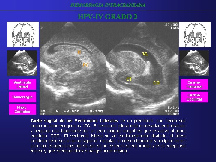 HEMORRAGIA INTRACRANEANA HPV-IV GRADO 3 H VL PC Ventrículo Lateral CT CO Hemorragia Plexo HEMORRAGIA INTRACRANEANA HPV-IV GRADO 3 H VL PC Ventrículo Lateral CT CO Hemorragia Plexo