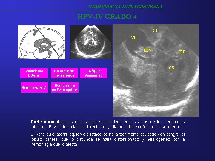 HEMORRAGIA INTRACRANEANA HPV-IV GRADO 4 CI VL HIV Ventrículo Lateral Cisura Inter hemisférica Hemorragia HEMORRAGIA INTRACRANEANA HPV-IV GRADO 4 CI VL HIV Ventrículo Lateral Cisura Inter hemisférica Hemorragia