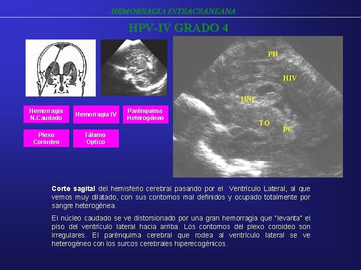 HEMORRAGIA INTRACRANEANA HPV-IV GRADO 4 PH HIV HNC Hemorragia N. Caudado Hemorragia IV Plexo HEMORRAGIA INTRACRANEANA HPV-IV GRADO 4 PH HIV HNC Hemorragia N. Caudado Hemorragia IV Plexo