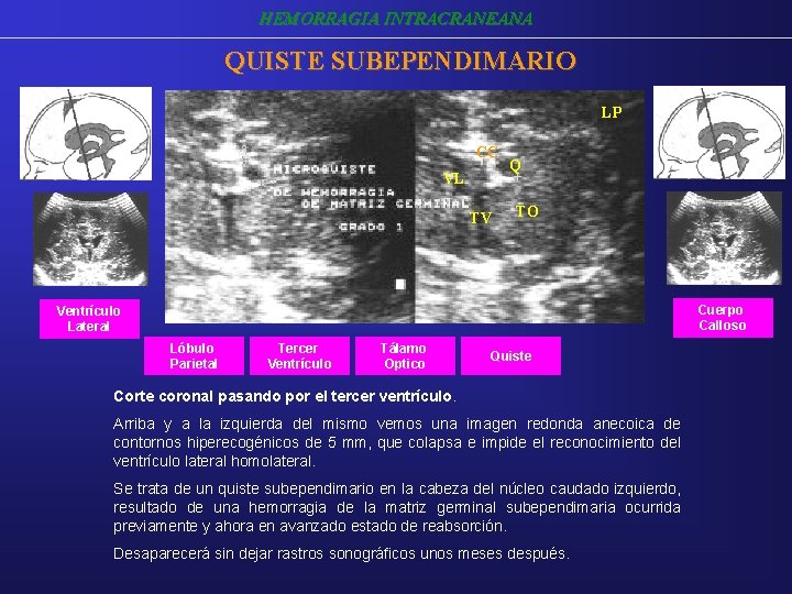 HEMORRAGIA INTRACRANEANA QUISTE SUBEPENDIMARIO LP CC VL TV Q TO Cuerpo Calloso Ventrículo Lateral HEMORRAGIA INTRACRANEANA QUISTE SUBEPENDIMARIO LP CC VL TV Q TO Cuerpo Calloso Ventrículo Lateral