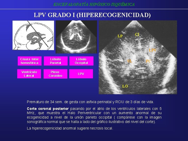 ENCEFALOPATÍA HIPÓXICO ISQUÉMICA LPV GRADO I (HIPERECOGENICIDAD) CI LP LPV Cisura Inter hemisférica Lóbulo ENCEFALOPATÍA HIPÓXICO ISQUÉMICA LPV GRADO I (HIPERECOGENICIDAD) CI LP LPV Cisura Inter hemisférica Lóbulo