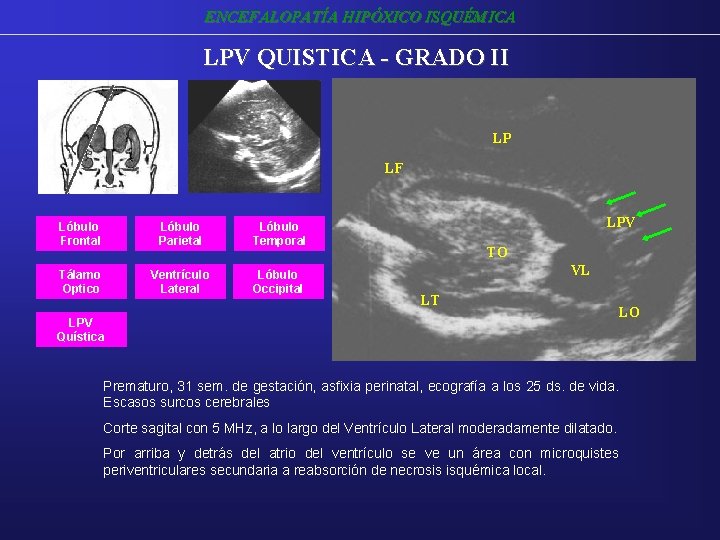 ENCEFALOPATÍA HIPÓXICO ISQUÉMICA LPV QUISTICA - GRADO II LP LF Lóbulo Frontal Lóbulo Parietal ENCEFALOPATÍA HIPÓXICO ISQUÉMICA LPV QUISTICA - GRADO II LP LF Lóbulo Frontal Lóbulo Parietal