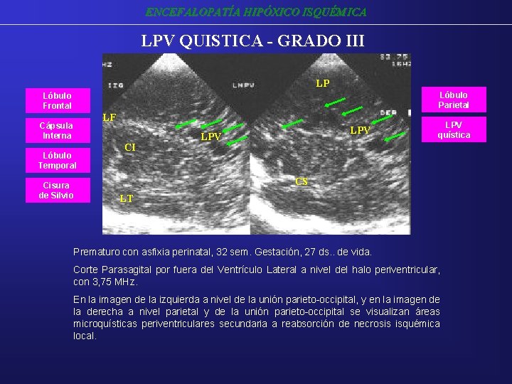 ENCEFALOPATÍA HIPÓXICO ISQUÉMICA LPV QUISTICA - GRADO III LP Lóbulo Parietal Lóbulo Frontal LF ENCEFALOPATÍA HIPÓXICO ISQUÉMICA LPV QUISTICA - GRADO III LP Lóbulo Parietal Lóbulo Frontal LF