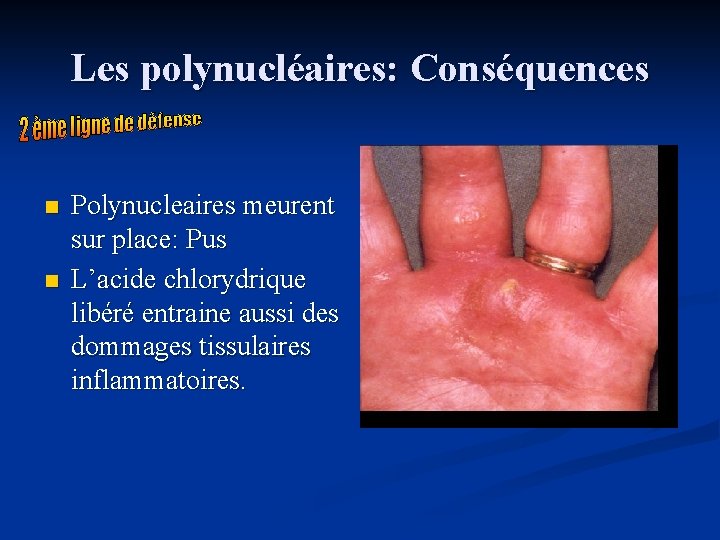 Les polynucléaires: Conséquences n n Polynucleaires meurent sur place: Pus L’acide chlorydrique libéré entraine