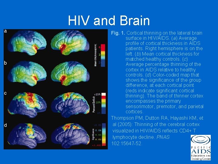 HIV and Brain Fig. 1. Cortical thinning on the lateral brain surface in HIV/AIDS.